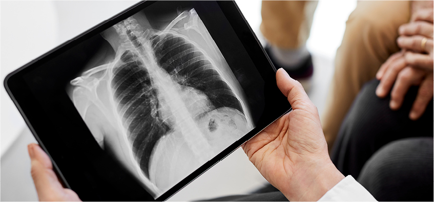 Doctor holding up x-ray of lung