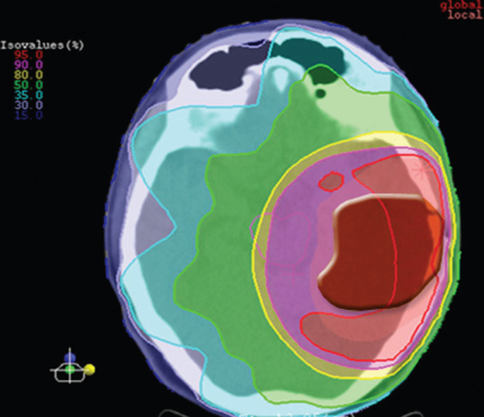 treatment-with-xray-imrt