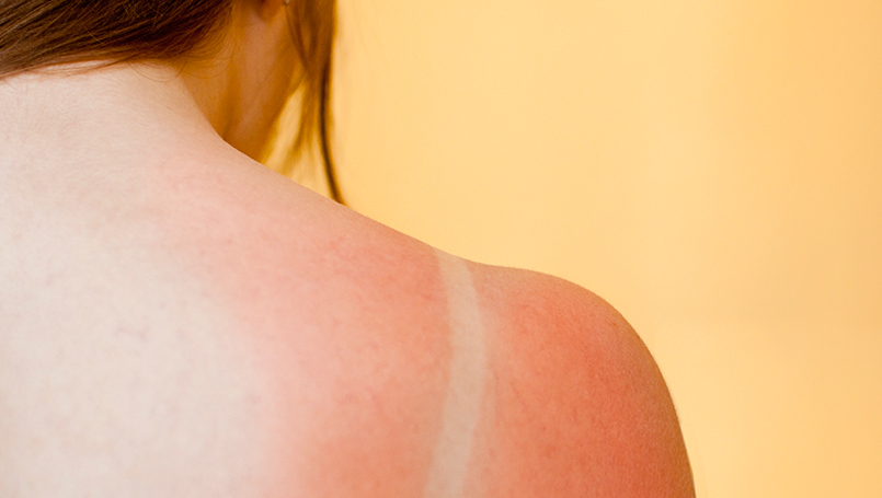 7 Natural Remedies to Soothe Sunburnt Skin