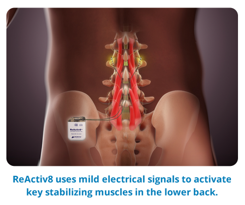 UC San Diego Health First in Nation to Implant New Device for Chronic Back  Pain