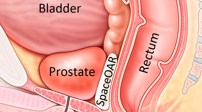 New gel reduces side effects of prostate cancer treatment | Beaumont Health