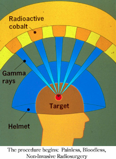 gamma-knife-summary-drawing