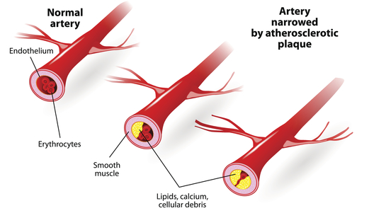 Calcium Scoring Heart Ct Test Heart Disease Tests Beaumont Health