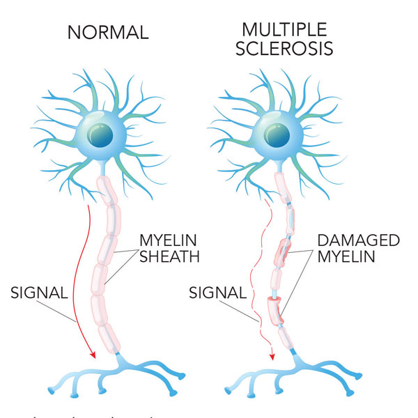Multiple sclerosis nerve cells