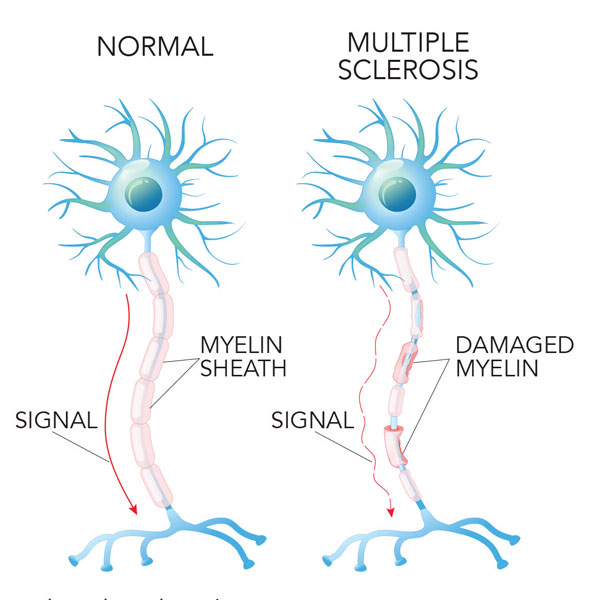 Image result for multiple sclerosis images