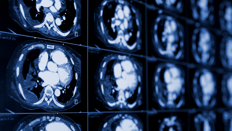 spread of mesothelioma