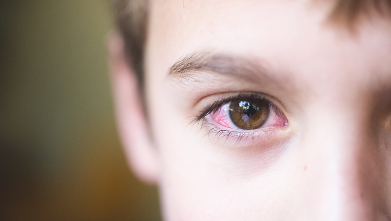 Pink eye