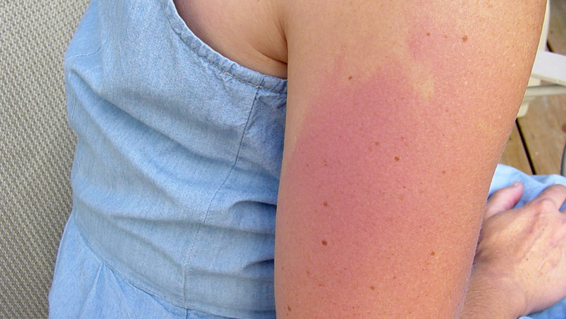 Why Is There a Rash Under Your Breast In Summers? Life Style - East News