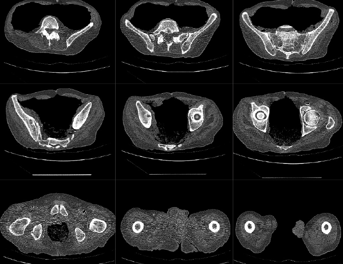 hip-ct