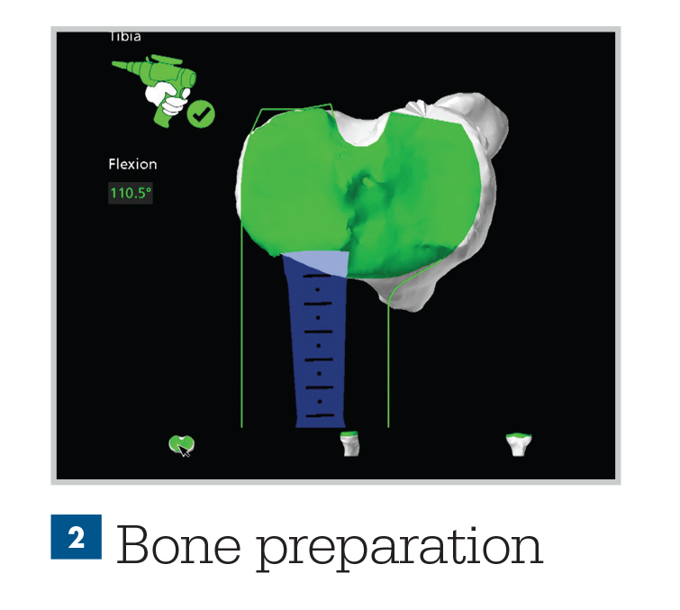 knee-personalized-preoperative-plan