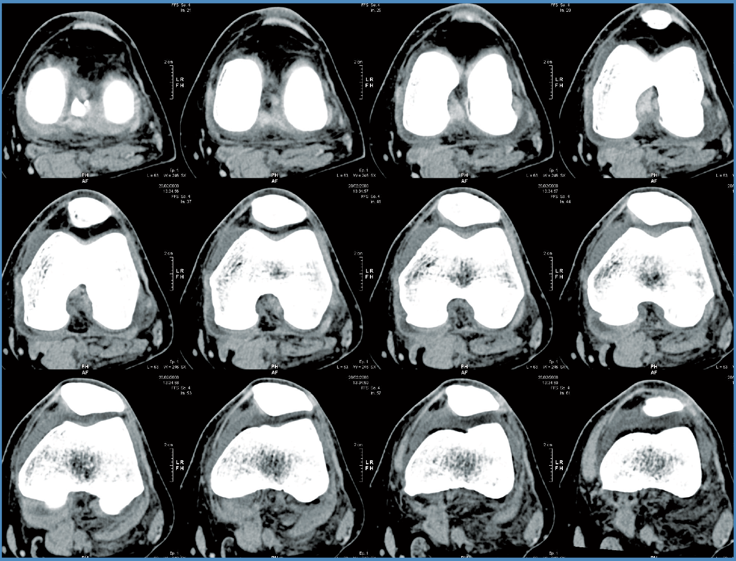 knee-ct-scan