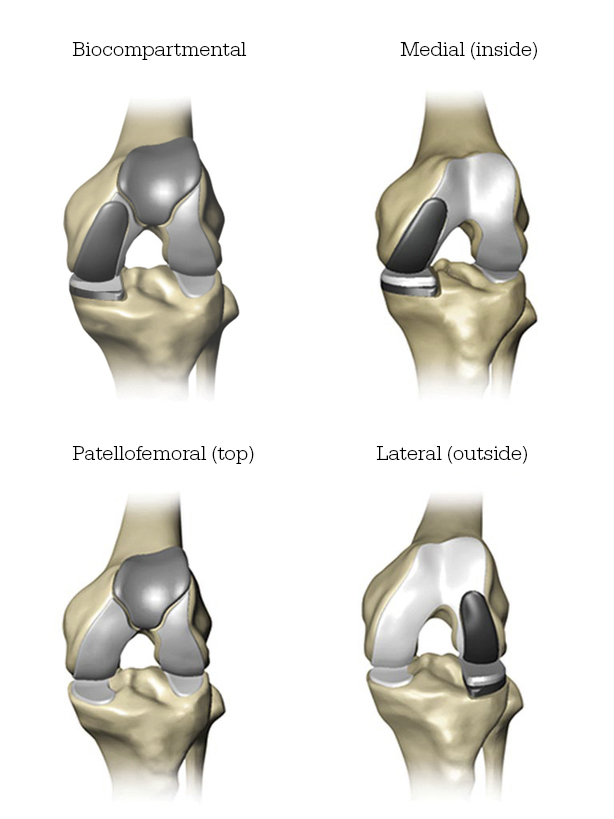 knee-implant-areas