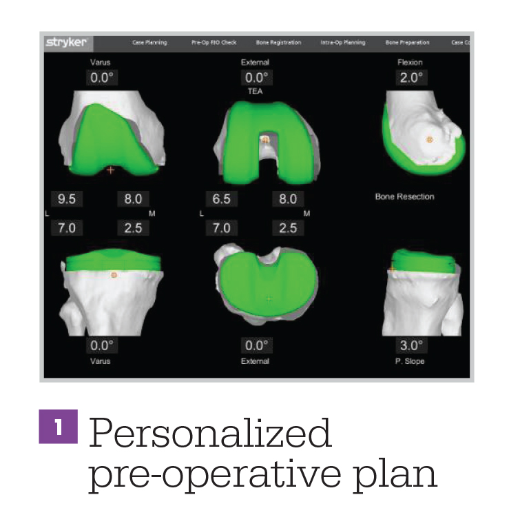 knee-personalized-preoperative-plan
