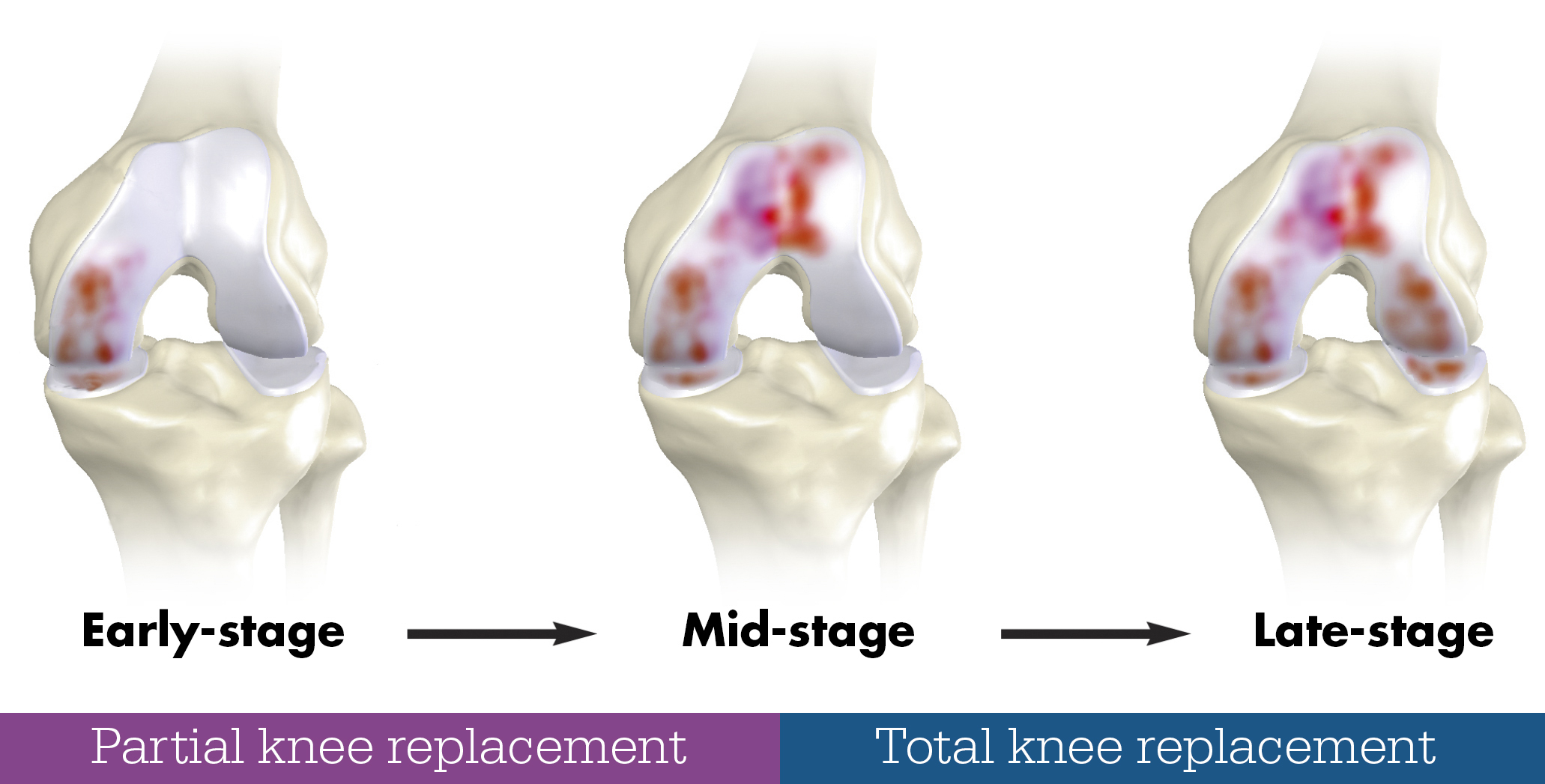total-knee-partial-knee