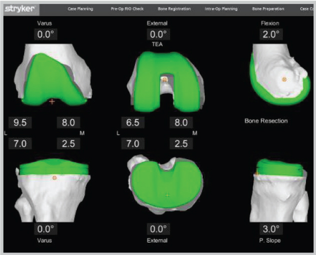 total-knee-personalized-planning