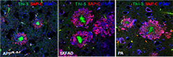 Dysfunctional Lysosomal Clustering