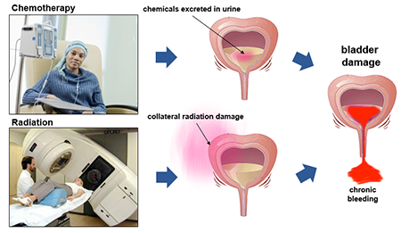 Radiation Cystitis chemo