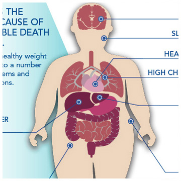 Obesity