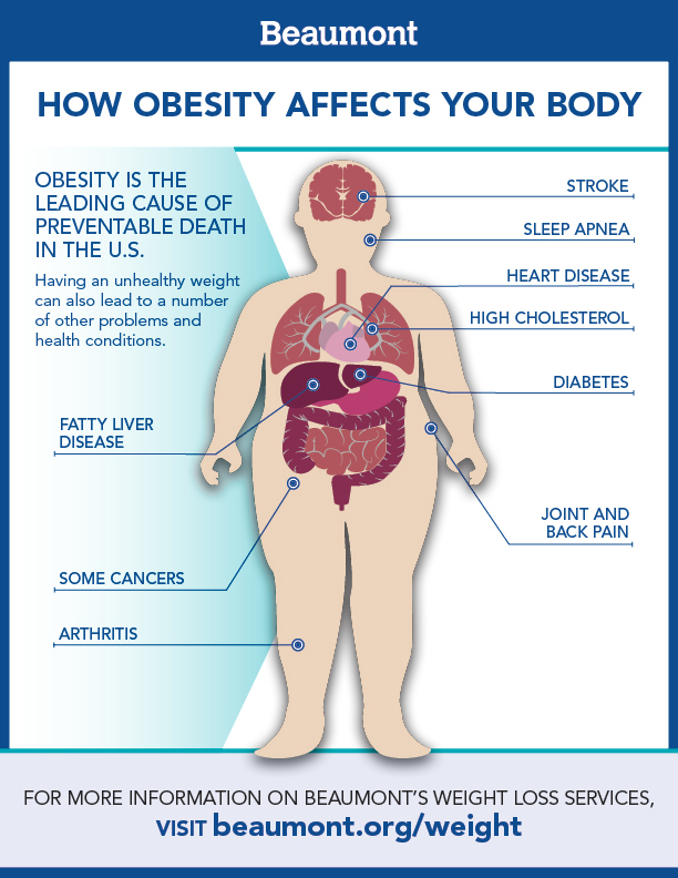 Weight Loss Beaumont Health