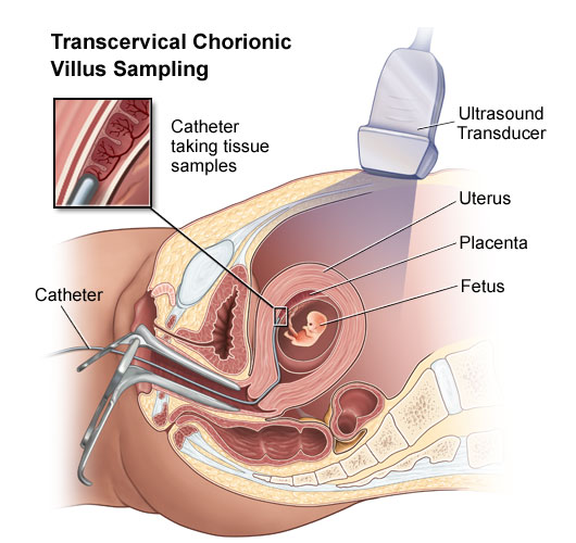 Chorionic Villus Sampling