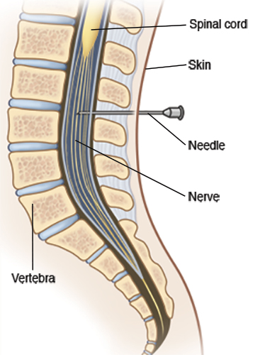 Epidural