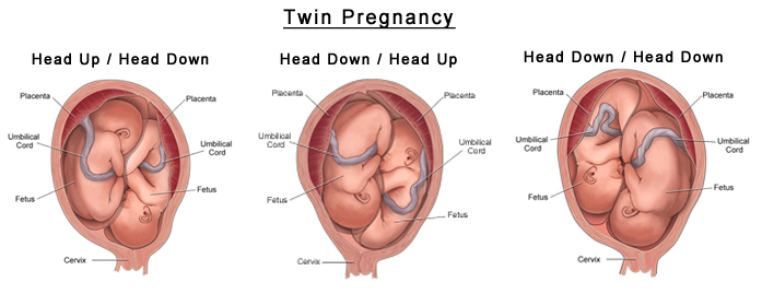 MultiplePregnancys MultiplePregnancys