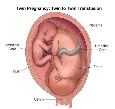 Complications of multiple pregnancy